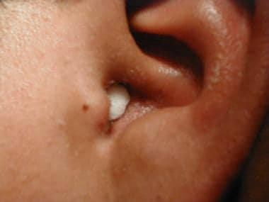 ACUTE OTITIS EXTERNA IN CHILDREN