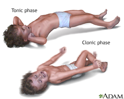 TREATMENT OF CONVULSIONS IN CHILDREN